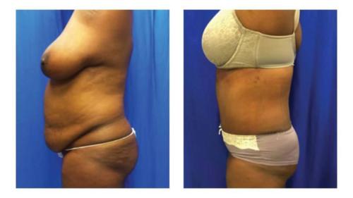 Tummy-Tuck-Liposuction-13_Before-After_Dr-Michael-Jones