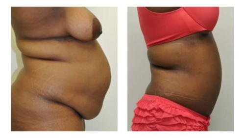 Tummy-Tuck-Liposuction-19_Before-After_Dr-Michael-Jones