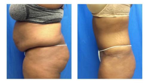 Tummy-Tuck-Liposuction-23_Before-After_Dr-Michael-Jones