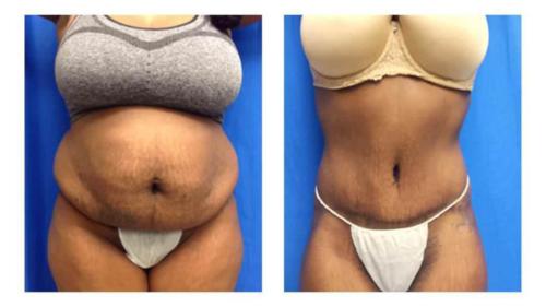 Tummy-Tuck-Liposuction-2_Before-After_Dr-Michael-Jones